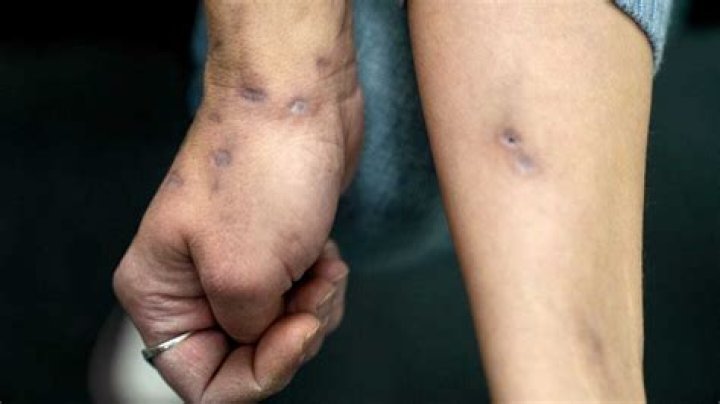 
What is Tranq? Zombie drugs wounds pictures sparks panic and concern online 